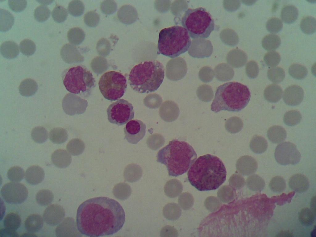 白血病干细胞移植后能活多久_白血病移植后能活多久_白血病移植后吃索拉非尼掉血向