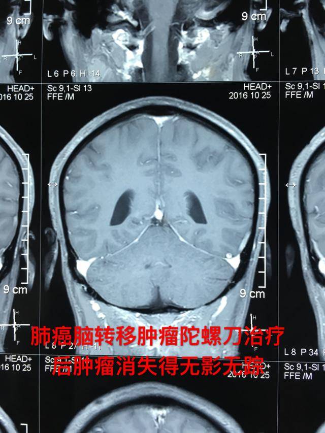 奥希替尼除了是肺癌靶向药外，对肺癌脑转移患者尤为有效！