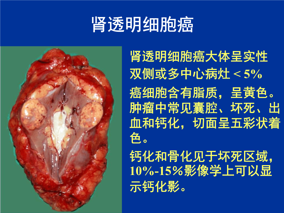 上海事业单位医疗招聘：肾细胞癌的分类及分类
