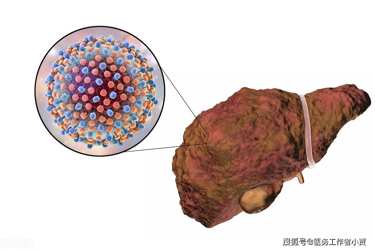 肝癌吃索拉非尼的效果_肝癌腹水能服索拉非尼_索拉非尼 裸鼠肝癌