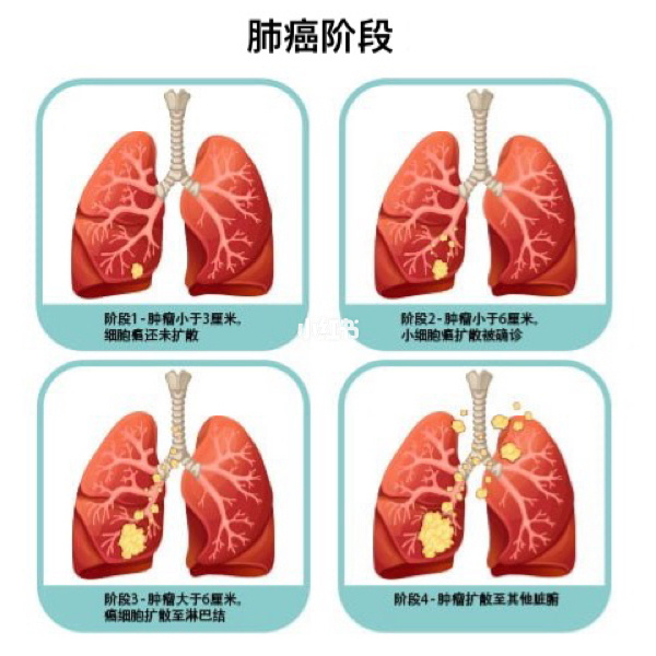 病情分析：你好，肺癌是最常见的肺原发性恶性肿瘤