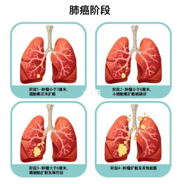 腺癌肺_晚期孕妇吃什么菜好_肺腺癌晚期疼痛吃吉非替尼好吗