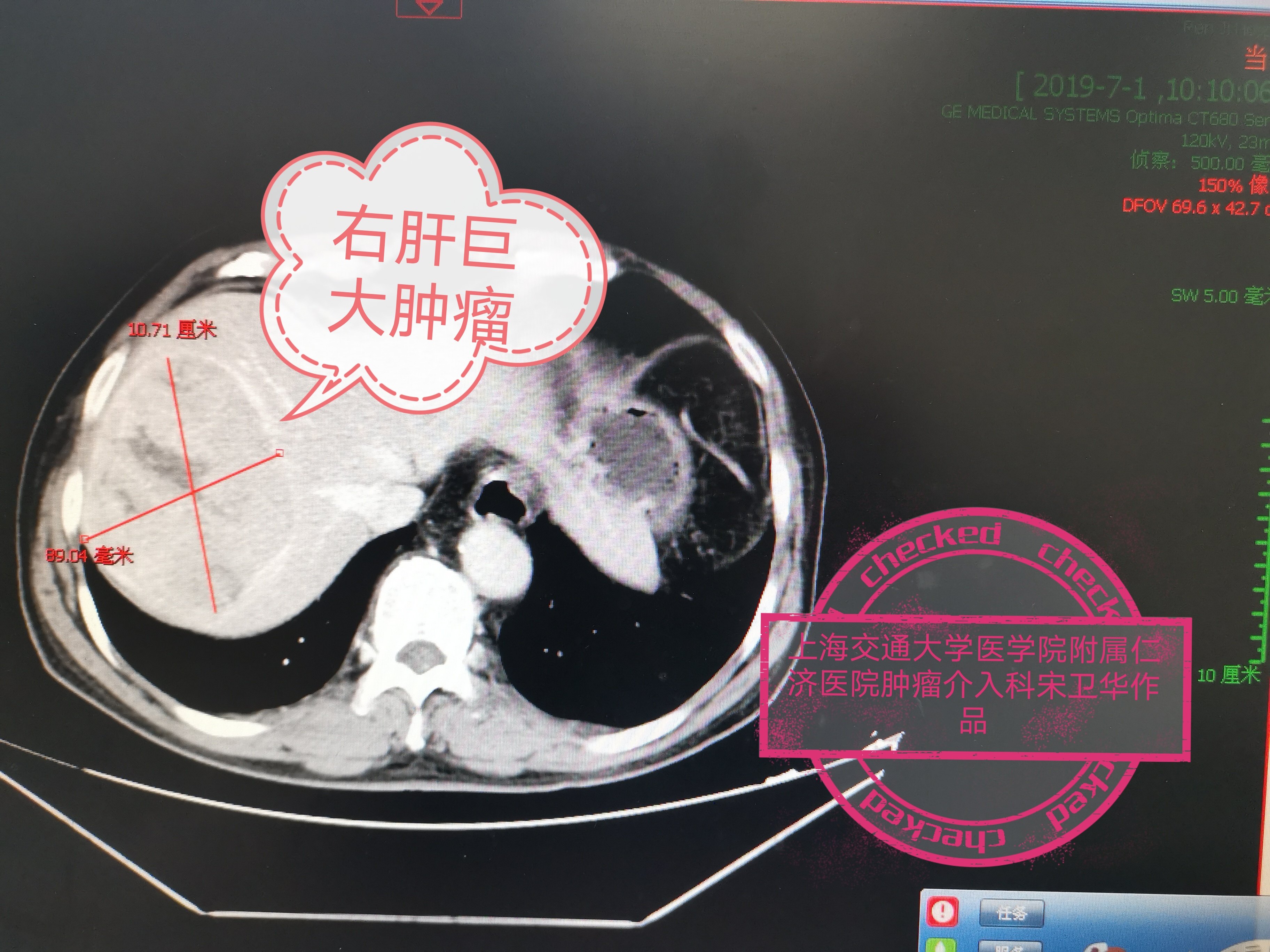 索拉非尼 裸鼠肝癌_肝癌晚期吃什么靶向药_肝癌靶向药索拉非尼怎么样