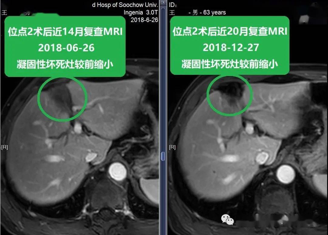 贝伐珠单抗副作用_不良反应_贝伐珠单抗靶向是啥_贝伐珠单抗价格