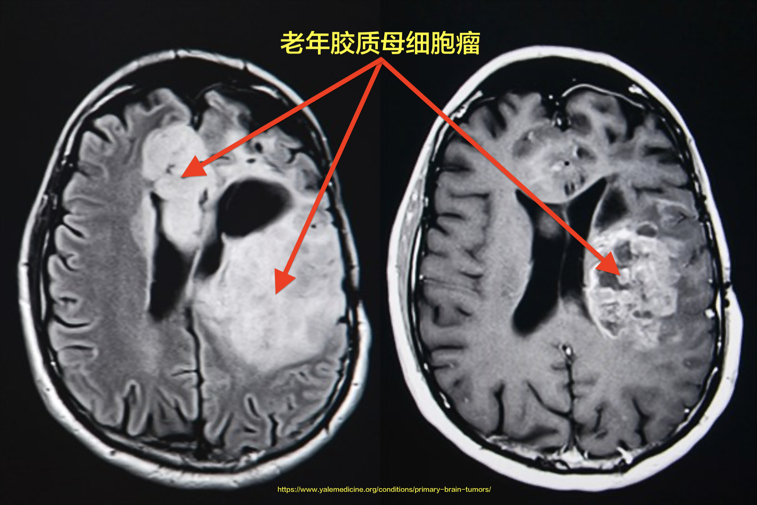 贝伐珠单抗4个月后赠药_贝伐珠单抗多少钱一支_贝伐珠单抗要化疗