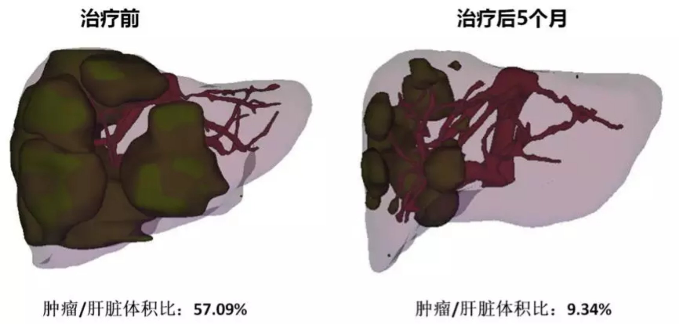 贝伐珠单抗治疗肺腺癌_贝伐单抗治疗直肠癌转移肝_贝伐珠单抗