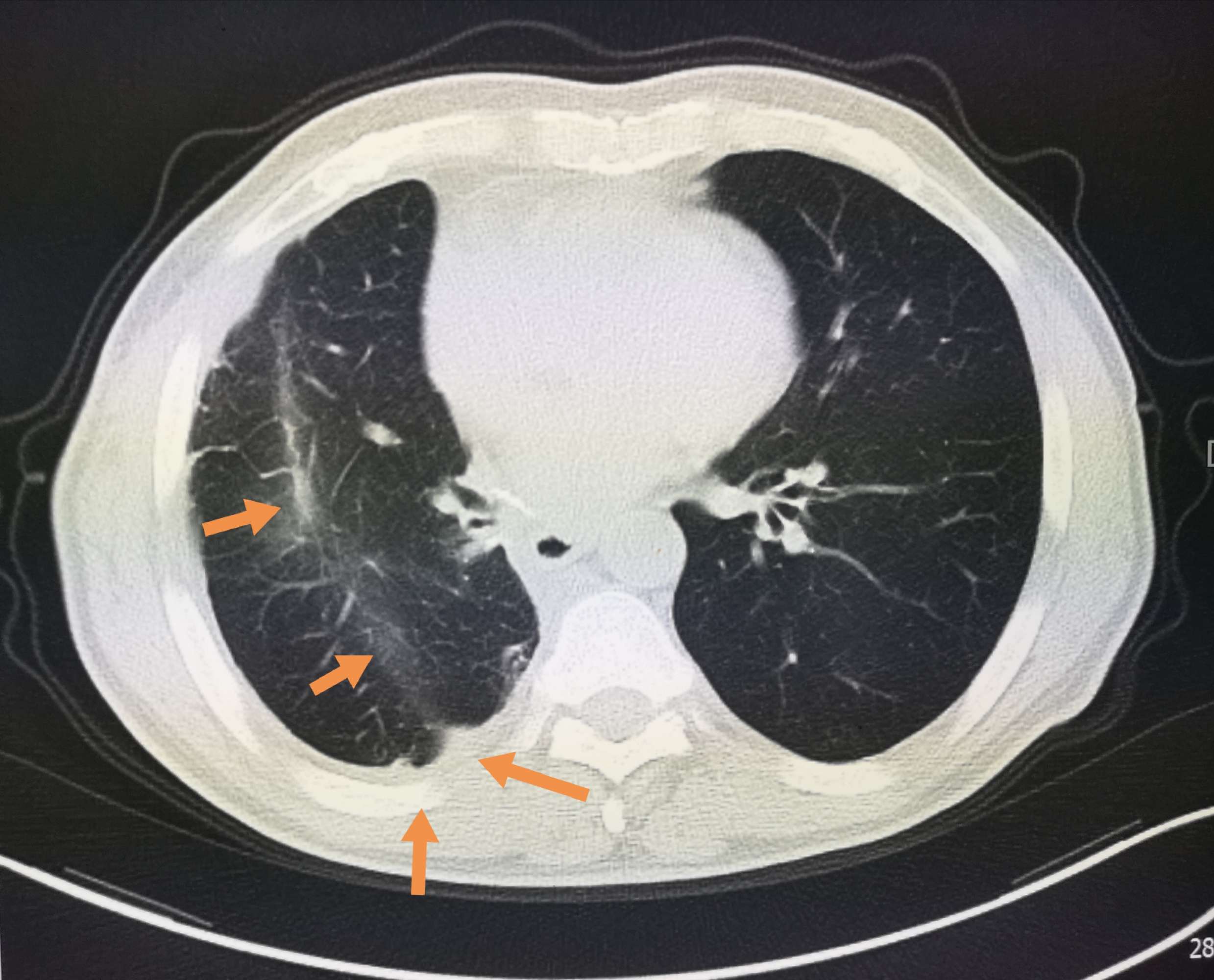 肺部磨玻璃阴影判断是肺原位癌或微浸润腺癌之所以重要