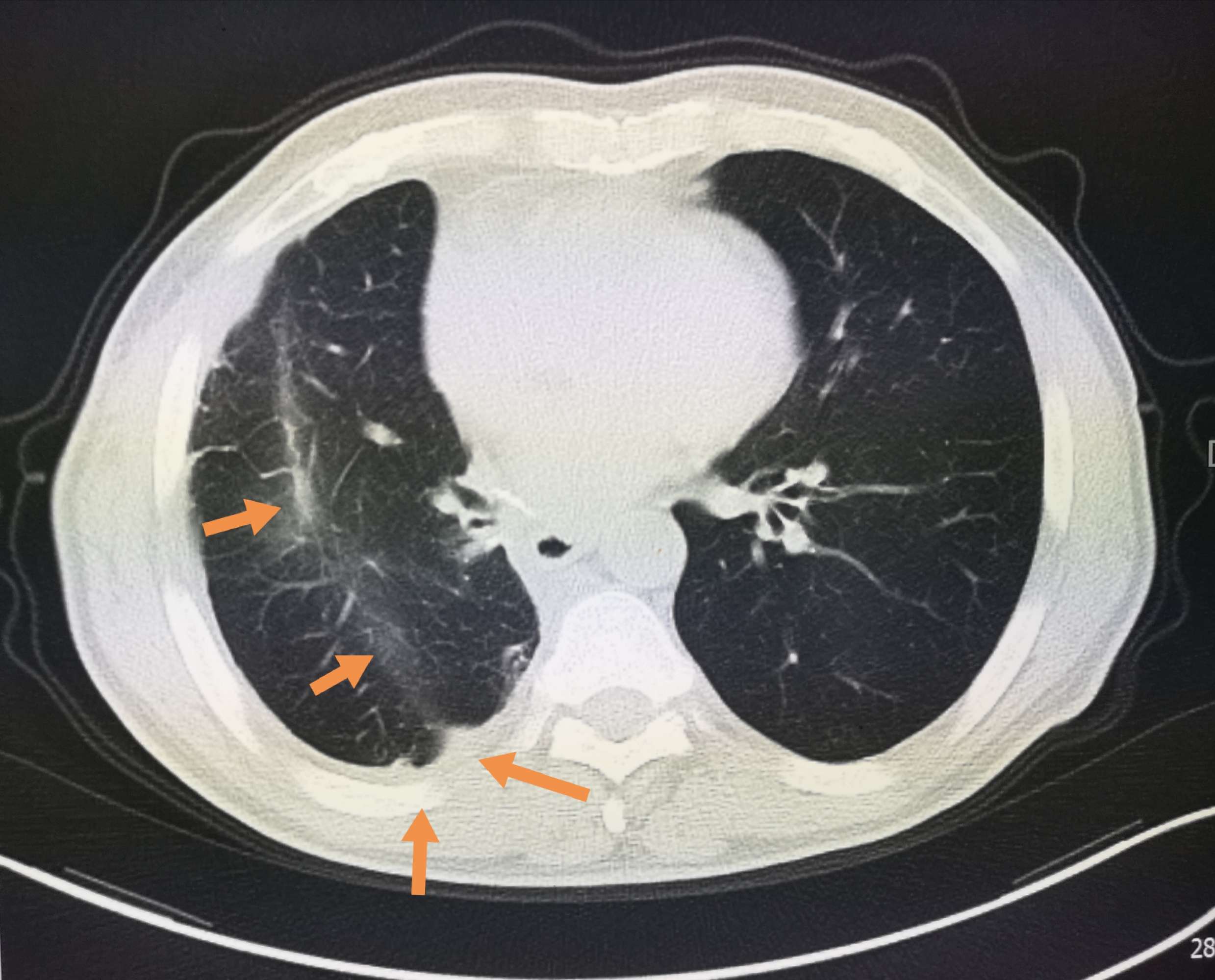 奥希替尼都有哪里产的_奥希替尼9291哪里买_肺腺癌奥希替尼胸膜