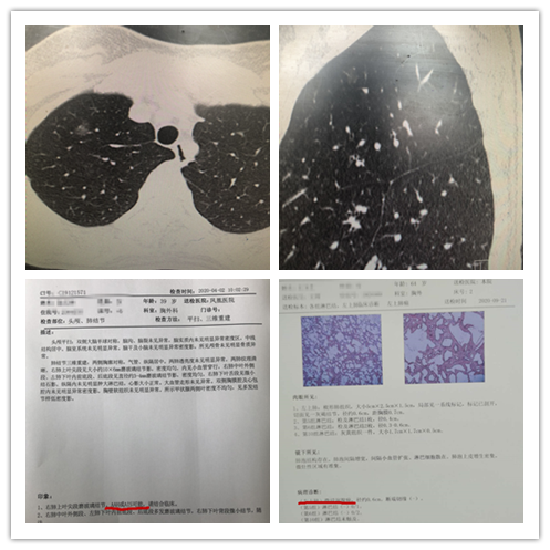 奥希替尼都有哪里产的_奥希替尼9291哪里买_肺腺癌奥希替尼胸膜