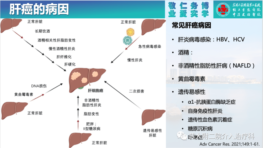 肝癌索拉非尼耐药细胞中的作用及潜在的分子机制研究