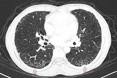 肺纤维化早期图片