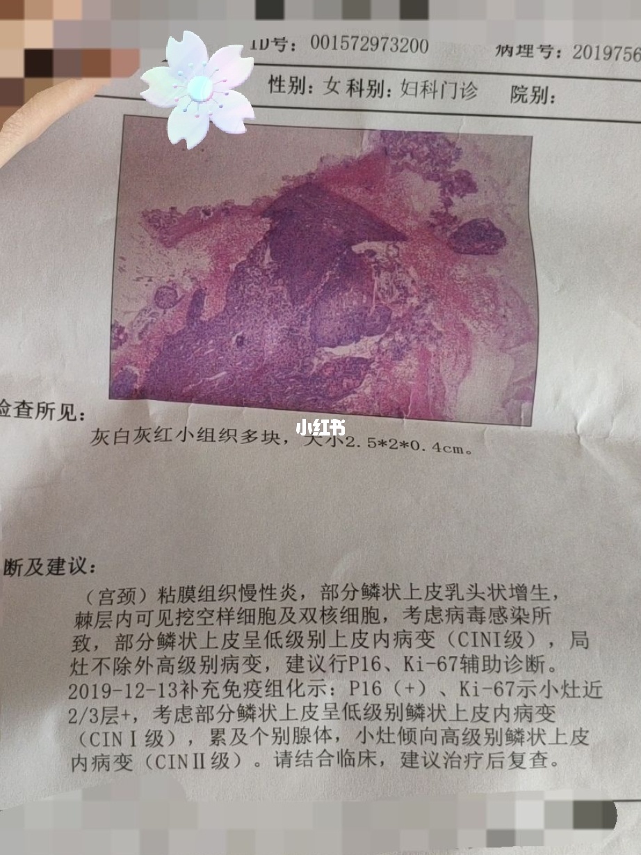 宫颈癌照片 初期 出血图片